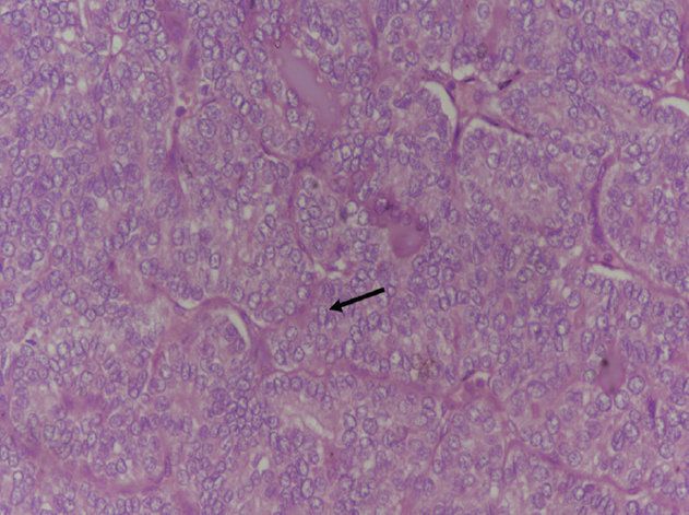 High-power view (H and E, ×40) showing tumour cells are cuboidal to low columnar (arrow) with eosinophilic cytoplasm.
